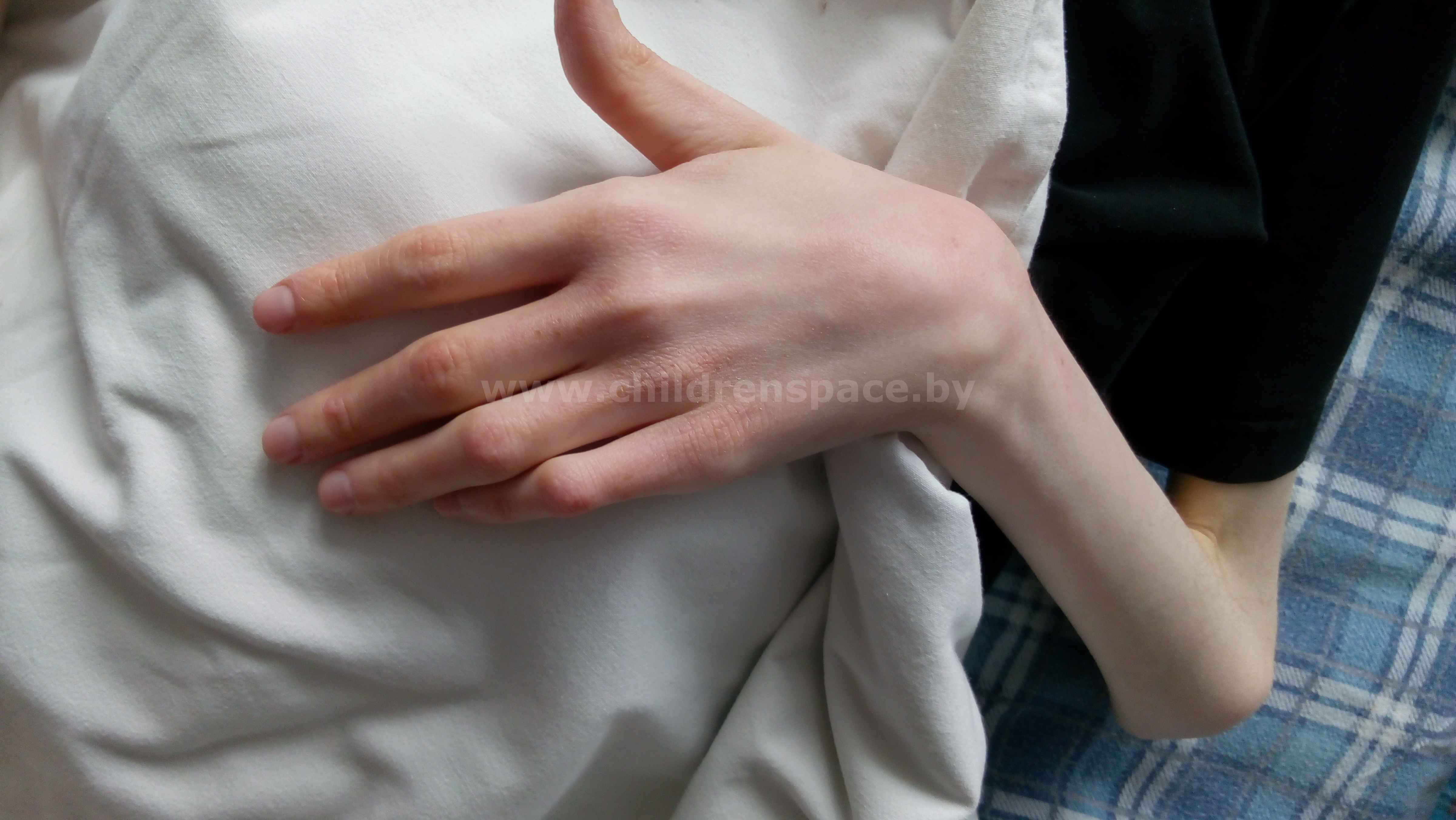 рука человека с синдромом марфана